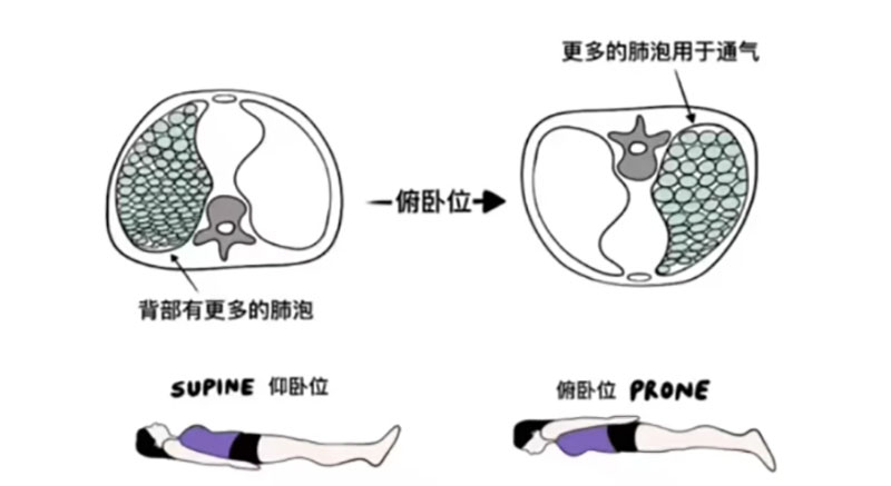 宁波海曙顾连康复医院|ICU开展俯卧位通气