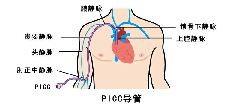 宁波海曙顾连康复医院PICC 置管维护科普:守护健康的 “生命通路”